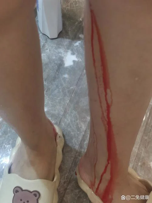 梦见流产了,流了好多血-梦见流产出血多