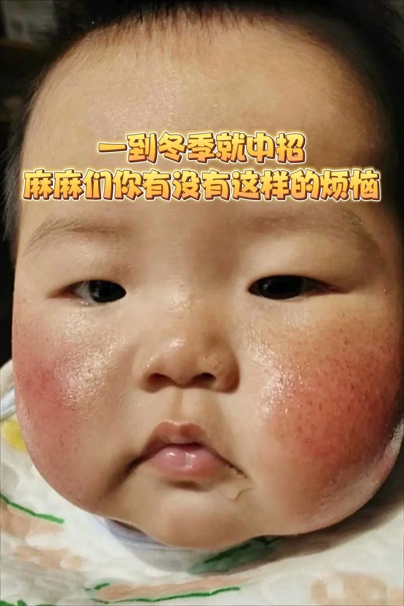 冬天脸被冻伤了怎么办_2