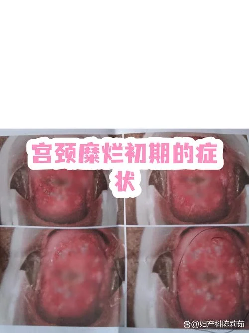 如何查宫颈糜烂_1