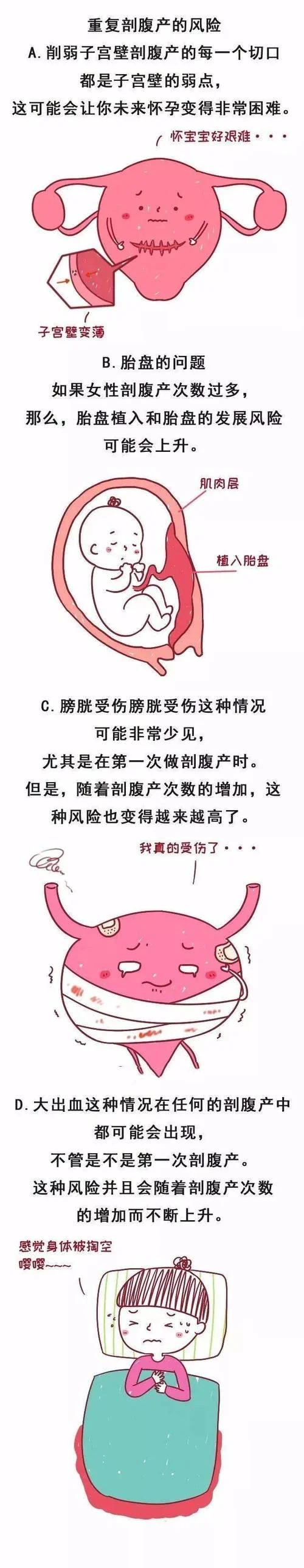 剖腹产历史简介_1