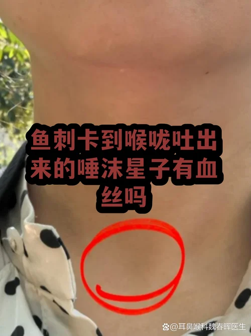 做梦吃鱼被鱼刺卡住_1