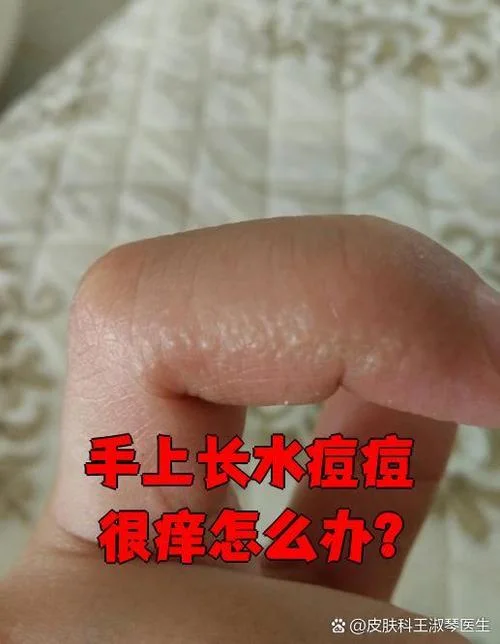 皮肤长水痘过敏了怎么办-过敏长水痘怎么办