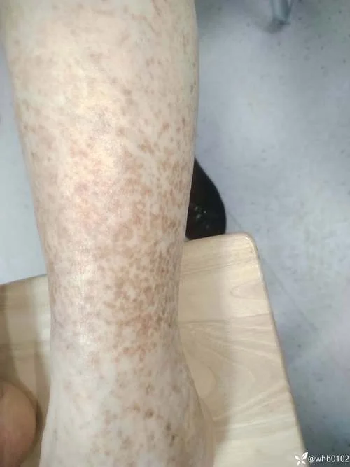 黑色素沉淀该怎么办-清除黑色素沉淀