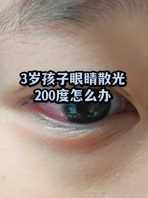 婴儿眼睛散光怎么办-婴儿散光怎么治