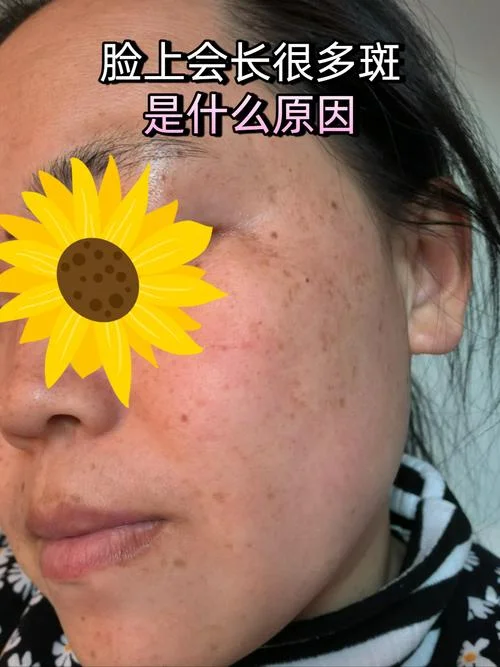梦见自己脸上斑很明显-梦面斑显眼