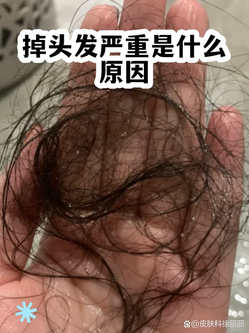梦见大把大把的掉头发什么征兆-大把掉发征兆