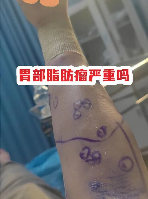 梦见胃里长个瘤_2
