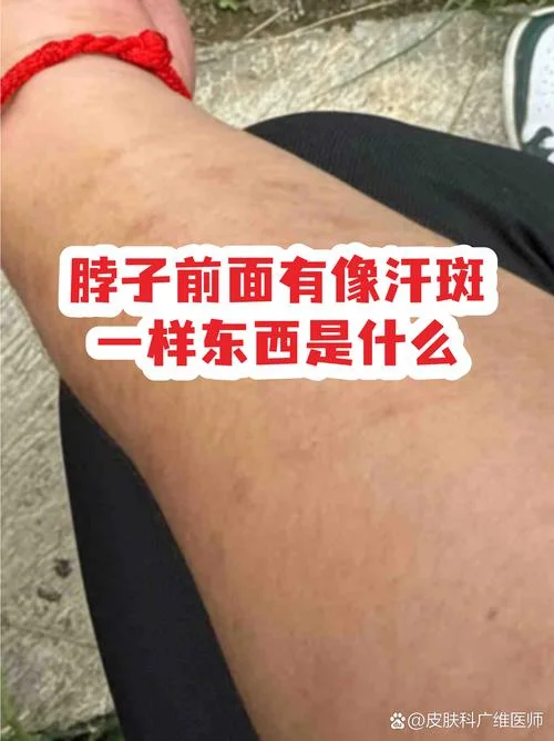汗斑是身体缺什么引起的_1