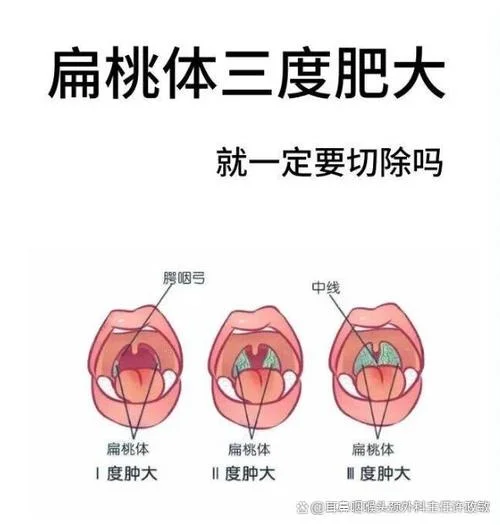 小孩扁桃体肿大一直不消怎么办-小孩扁桃体肿大不退