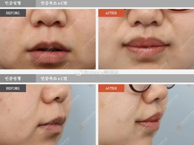 什么是人中缩短术_1