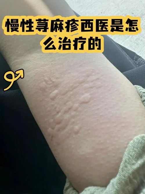 荨麻疹是什么意思_1