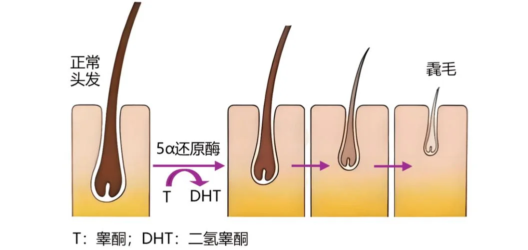 什么是dht脱发_2