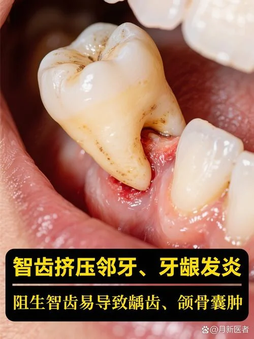 多余的牙齿叫什么牙_2