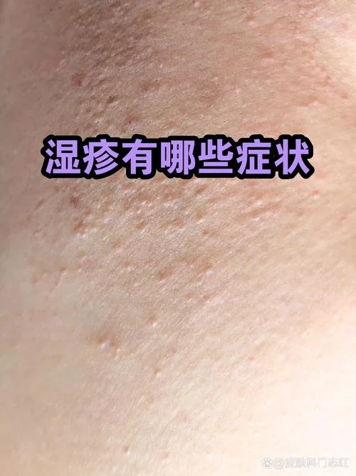 老是长湿疹是缺什么_1