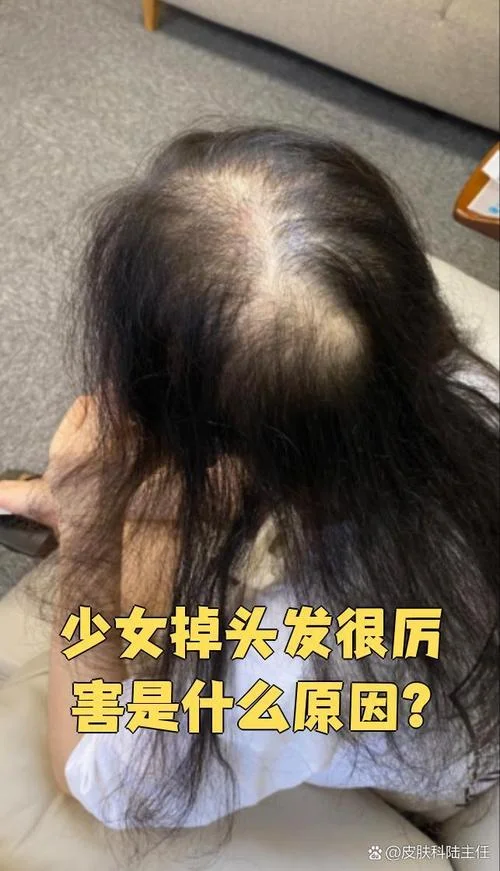 梦见自己脱了好多头发_1