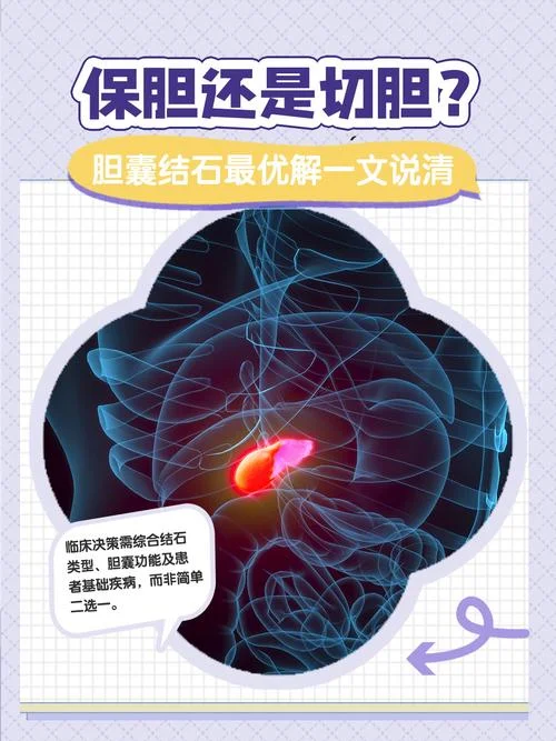 胆结石治疗方法出处_1
