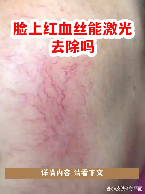 什么是红血丝脸_1