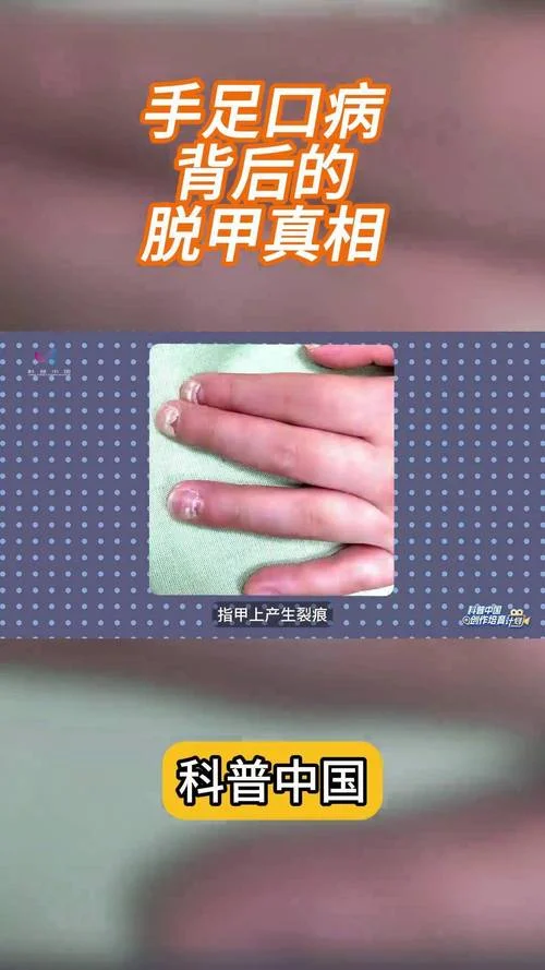 梦见美甲脱落怎么回事-梦见美甲脱落预示