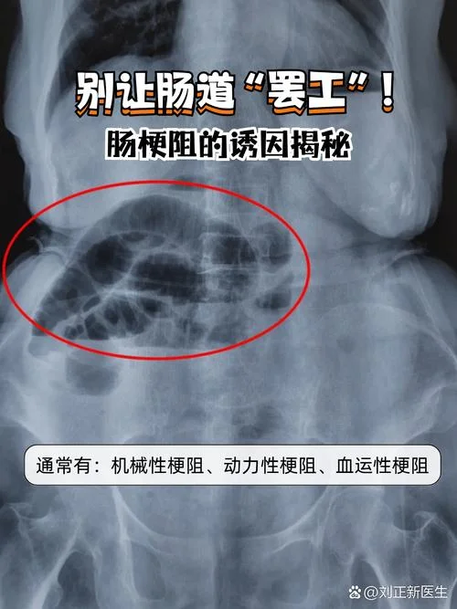 什么是肠梗阻有什么症状_1