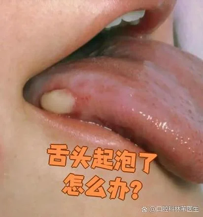 舌头被烫起泡了怎么办-舌头起泡立即处理