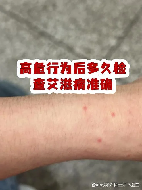 出国留学要体检hiv-留学出国体检HIV