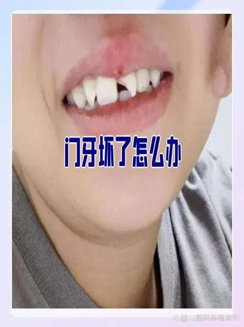 门牙坏了怎么办好_2