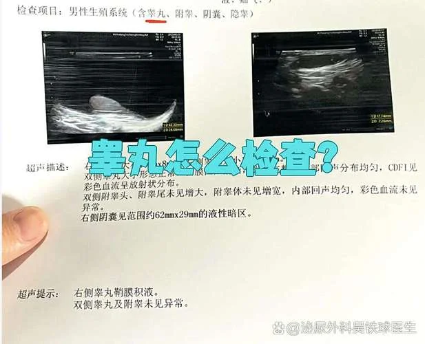 结核睾丸炎查什么项目_1