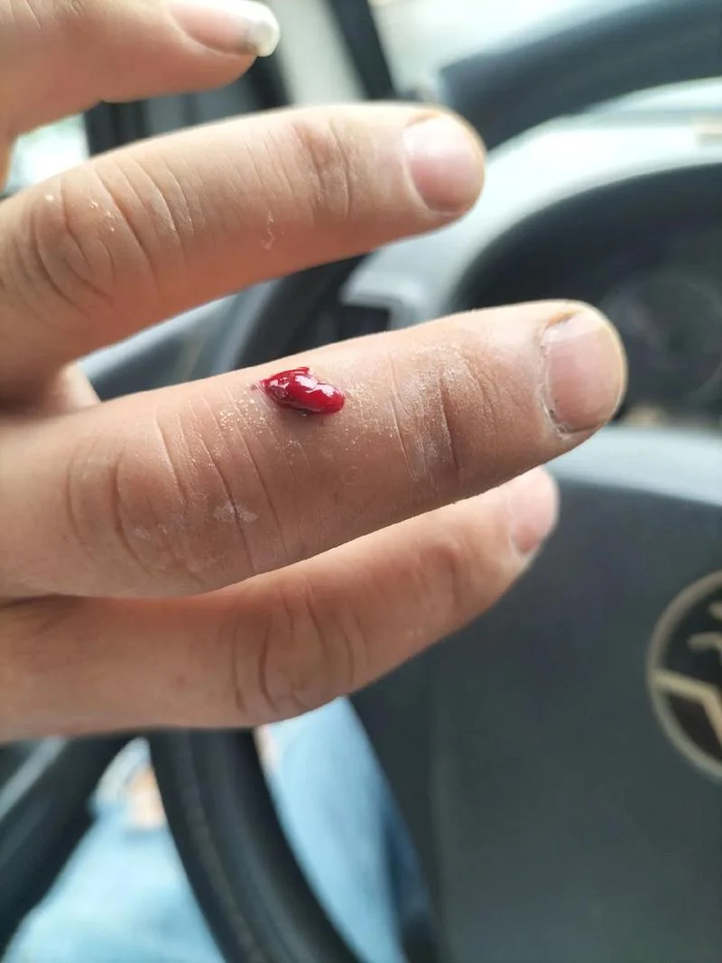 梦见自己手烂了一个洞_1