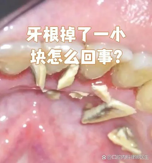 梦见牙结石掉了好多_2