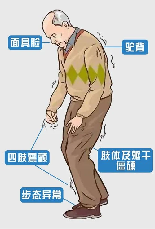 帕金森综合症又叫什么_2