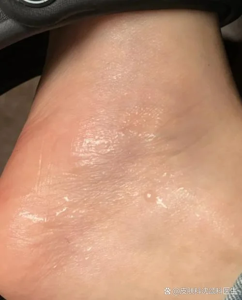 小孩脚出汗臭怎么办-小孩脚臭出汗如何消除