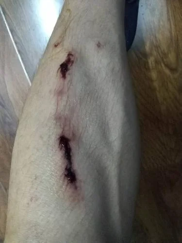 梦见腿被别人砍了_2