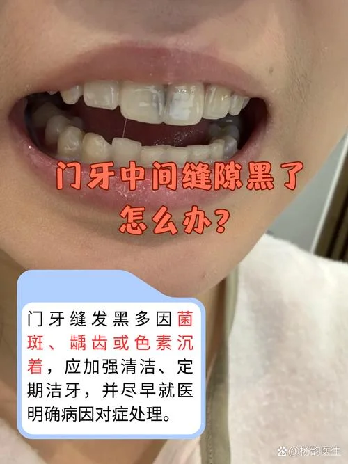 门牙坏了怎么办好_1