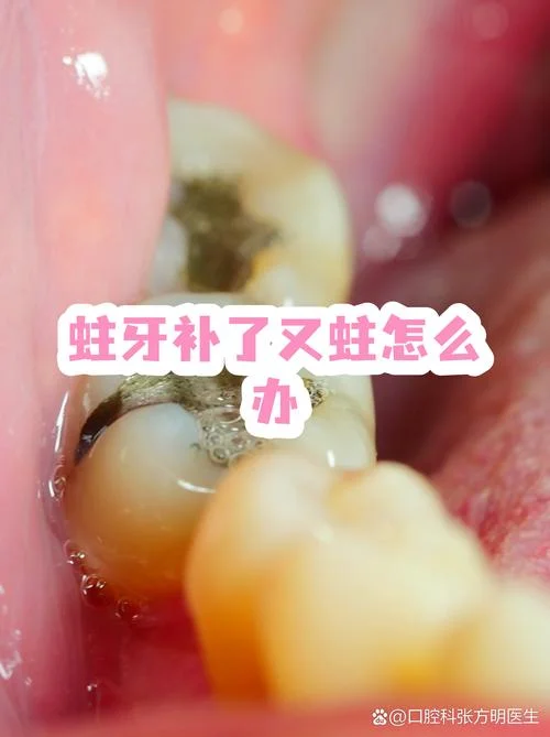 龋齿好痛怎么办-龋齿疼痛如何缓解