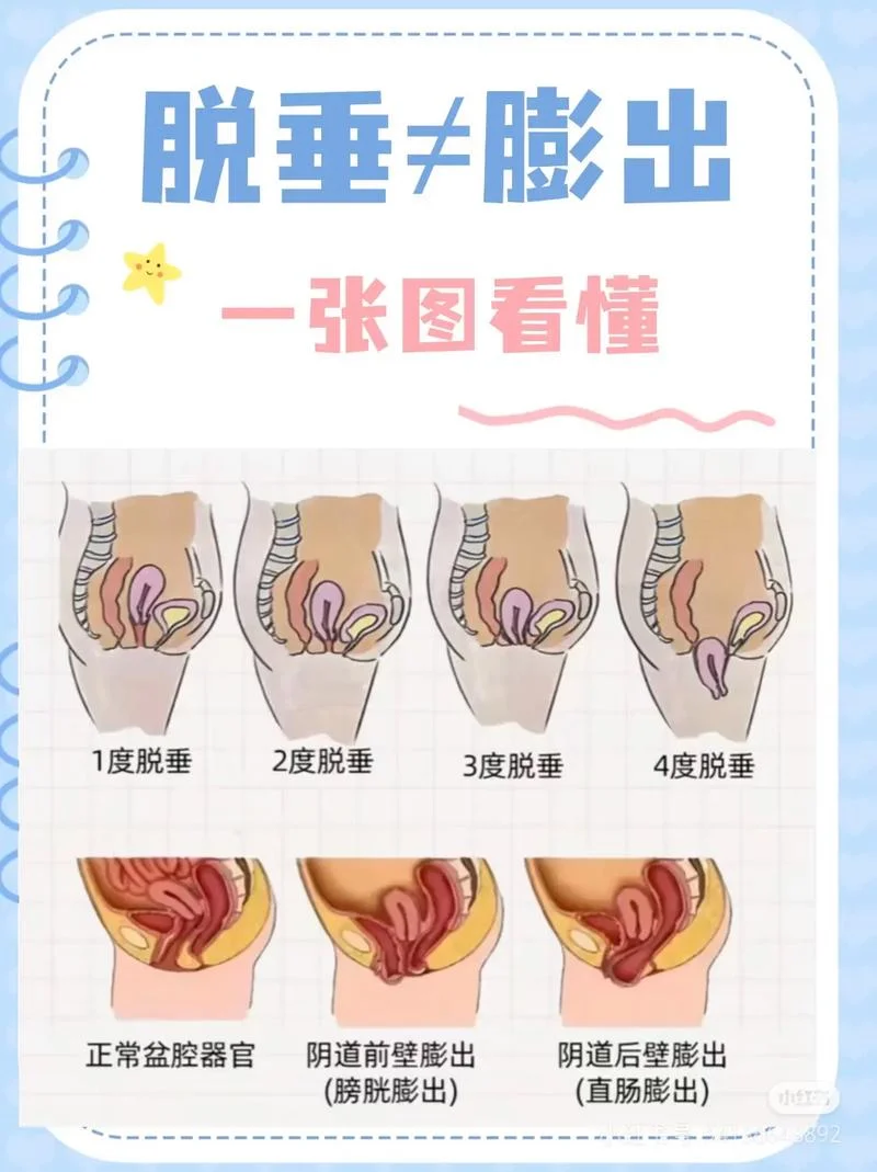 盆腔膨出怎么办-盆腔膨出怎么办