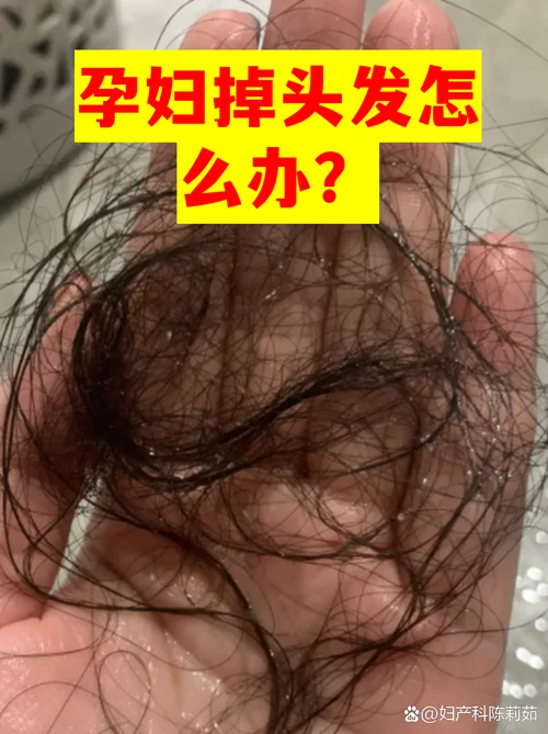 梦见自己大把大把的掉头发是怎么回事-掉发梦境成因探究