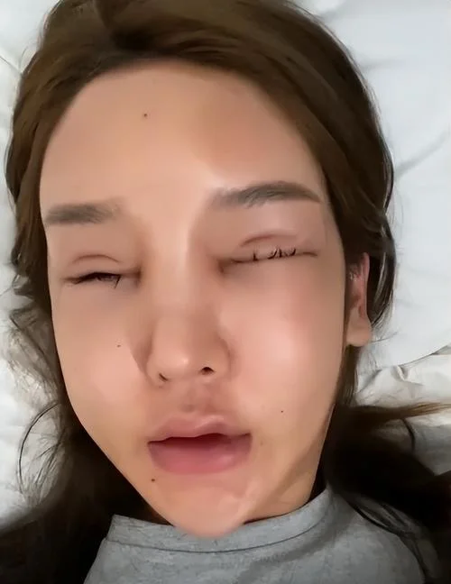 整容玻尿酸出处_1