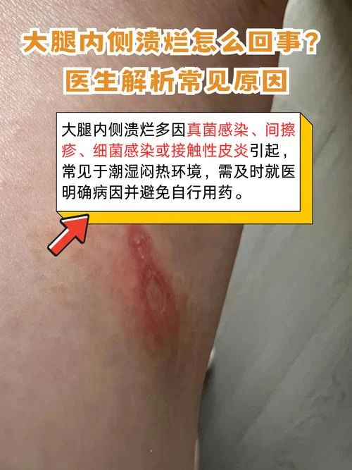 梦到皮肤溃烂-梦见皮肤溃烂