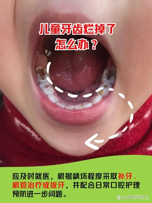 坏的牙齿叫什么_1
