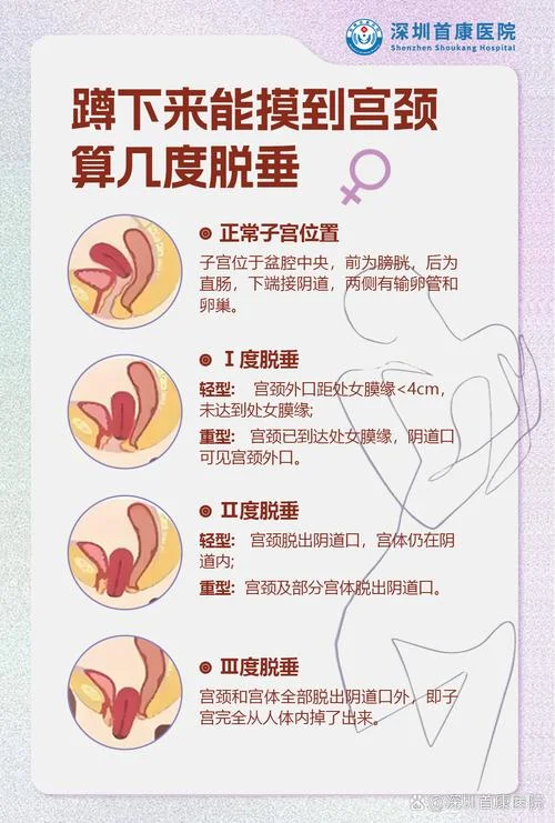 盆底筛查如何查_1
