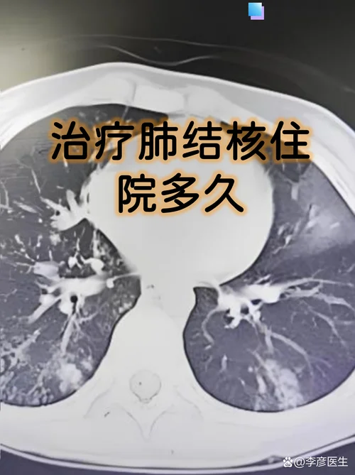 什么是浸润性肺结核_1