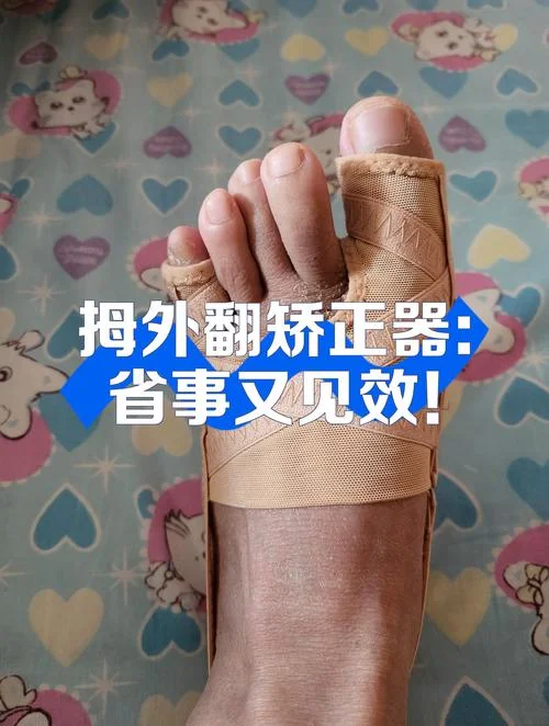 拇指外翻矫正器哪个牌子的好_1