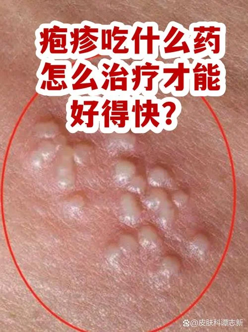 疱疹是啥病不能吃什么_1