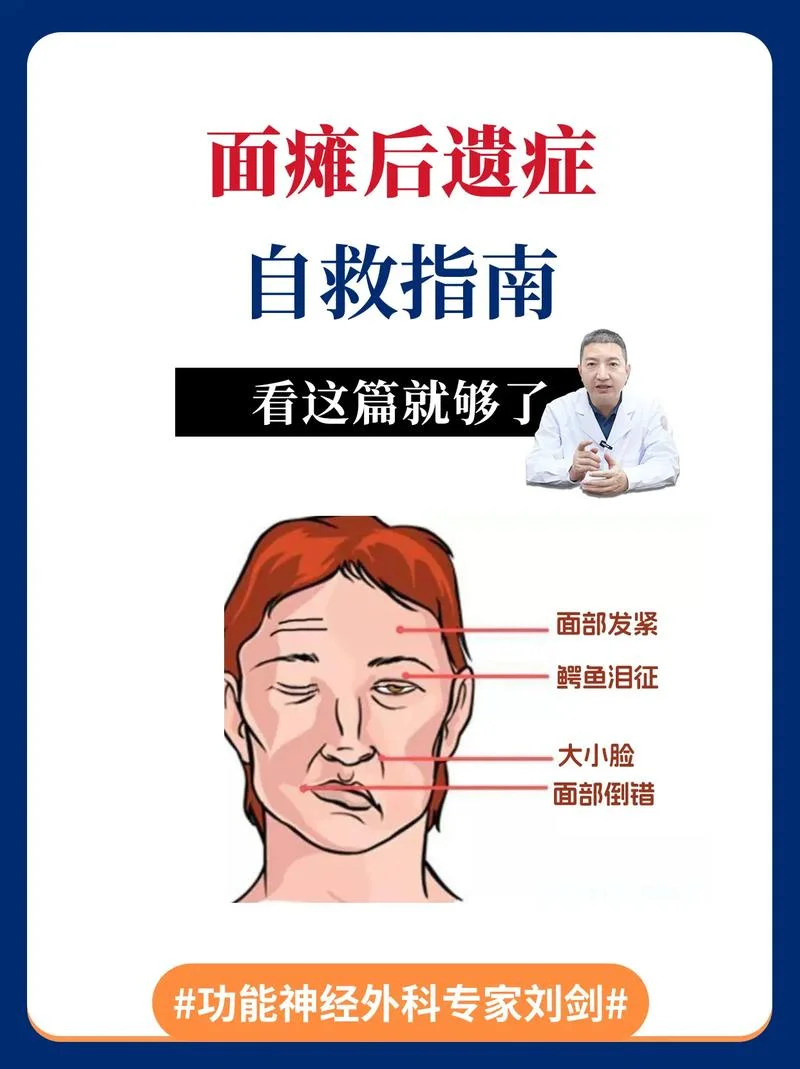 什么是面瘫原因_1