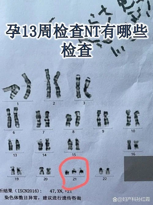 怀孕nt检查是什么项目_1