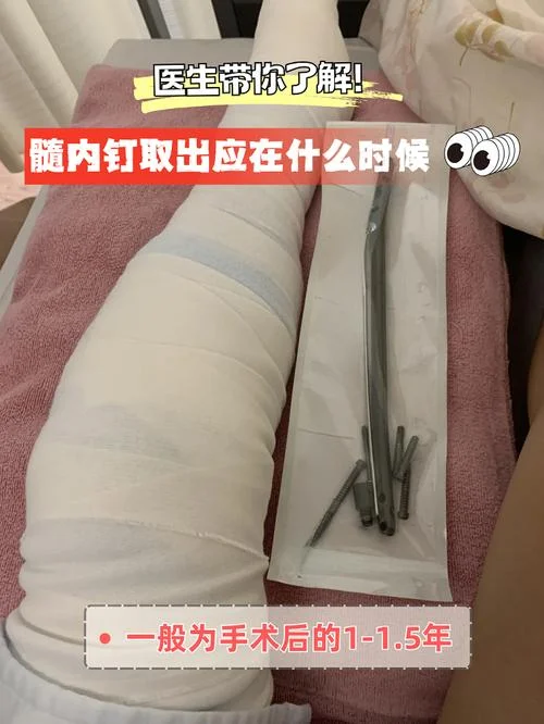 带锁髓内钉又叫什么_2