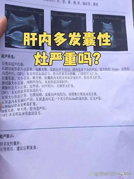 肝囊肿多大算严重了_2