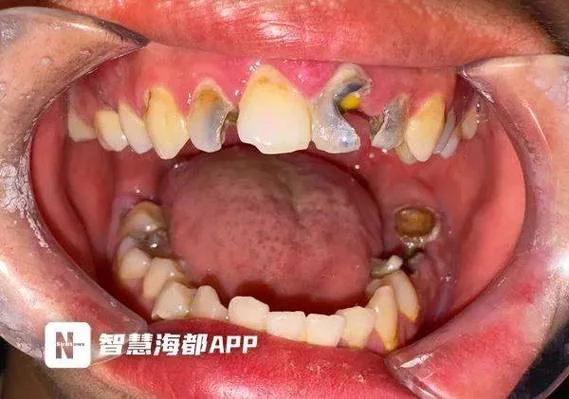 梦到自己拔掉烂牙_1