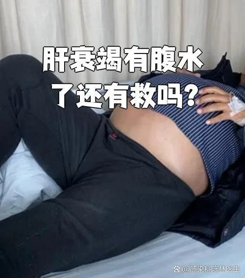 什么是肝衰竭晚期_2