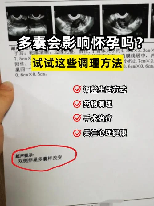 卵巢多囊综合征如何查_1